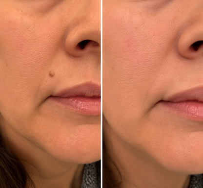 ✨🔥 50% SLEVA 🔥✨ PURESHADE® 2v1 mikrojehličková náplast 🍀 | Na znaménka, bradavice, akné a nedokonalosti pleti | Jemnější a čistší vzhled pokožky