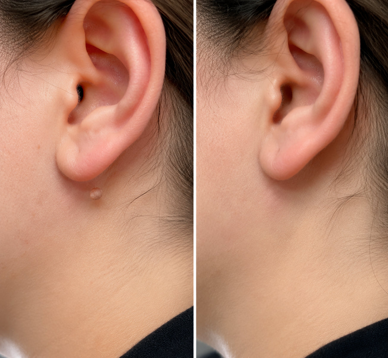 ✨🔥 50% SLEVA 🔥✨ PURESHADE® 2v1 mikrojehličková náplast 🍀 | Na znaménka, bradavice, akné a nedokonalosti pleti | Jemnější a čistší vzhled pokožky