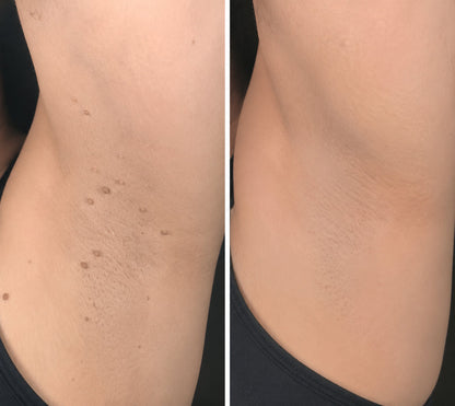✨🔥 50% SLEVA 🔥✨ PURESHADE® 2v1 mikrojehličková náplast 🍀 | Na znaménka, bradavice, akné a nedokonalosti pleti | Jemnější a čistší vzhled pokožky