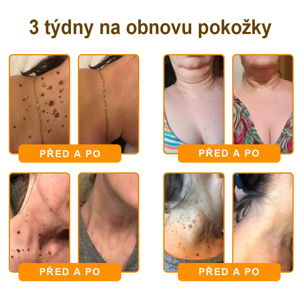 Bezbolestně a účinně odstraňuje různé typy bradavic 👨‍⚕️ APKAPK® krém na obnovu pokožky s včelím jedem pomáhá odstranit běžné, plantární, ploché a nitkovité bradavice, stejně jako papilomy