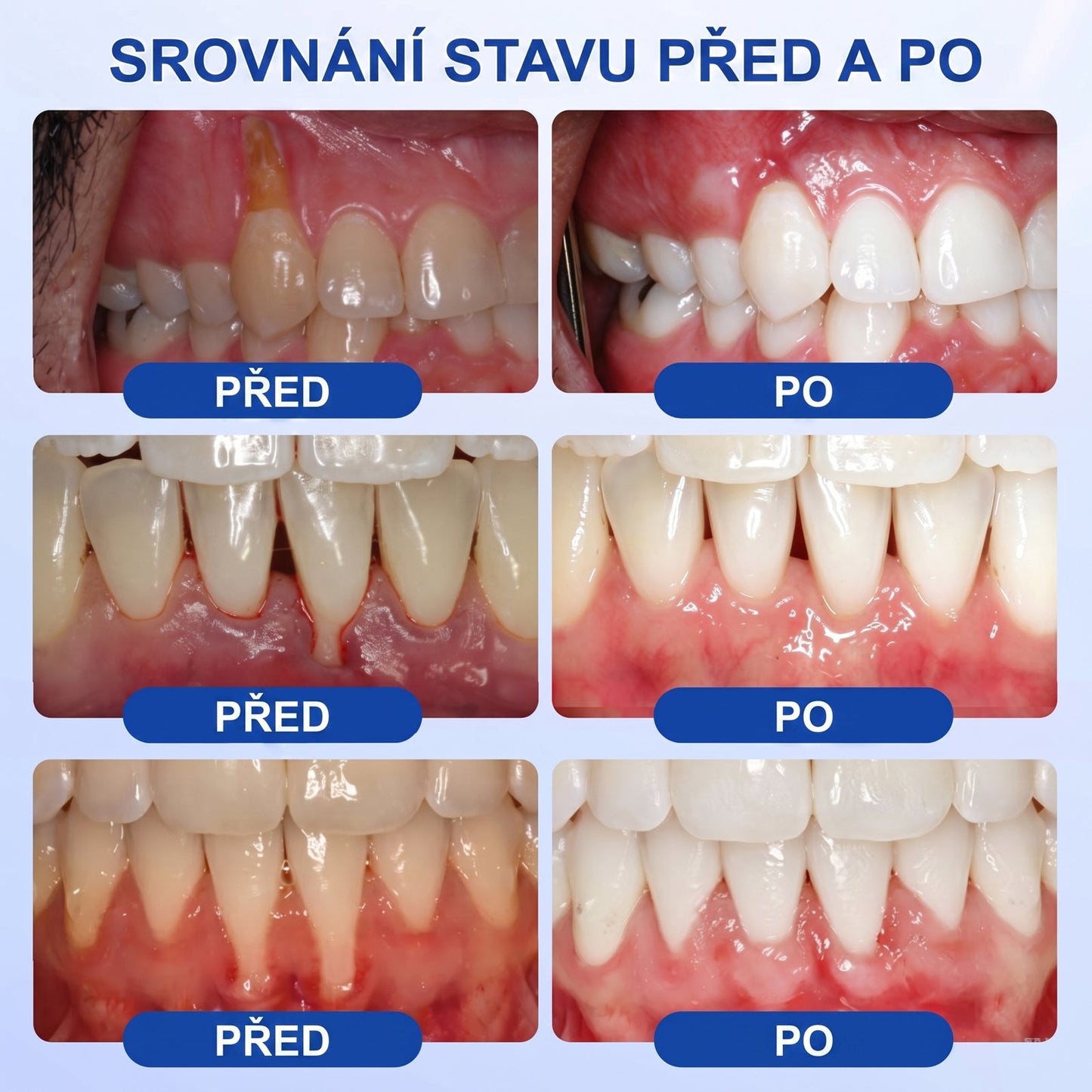 PureShade® 🦷 GumRevive regenerační gel na dásně – pro zdravější dásně a sebevědomější úsměv 👍
