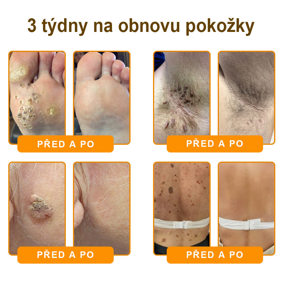 Bezbolestně a účinně odstraňuje různé typy bradavic 👨‍⚕️ APKAPK® krém na obnovu pokožky s včelím jedem pomáhá odstranit běžné, plantární, ploché a nitkovité bradavice, stejně jako papilomy