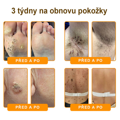 Bezbolestně a účinně odstraňuje různé typy bradavic 👨‍⚕️ APKAPK® krém na obnovu pokožky s včelím jedem pomáhá odstranit běžné, plantární, ploché a nitkovité bradavice, stejně jako papilomy