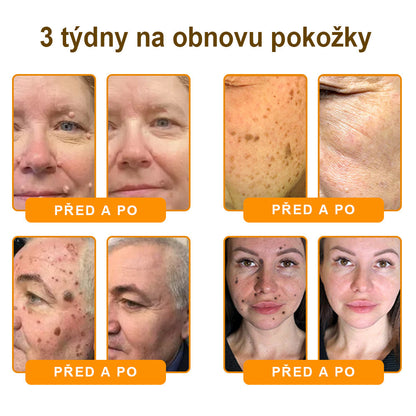 Bezbolestně a účinně odstraňuje různé typy bradavic 👨‍⚕️ APKAPK® krém na obnovu pokožky s včelím jedem pomáhá odstranit běžné, plantární, ploché a nitkovité bradavice, stejně jako papilomy