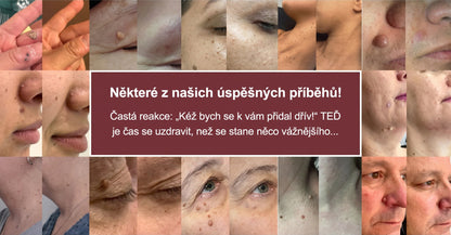 ✨🔥 50% SLEVA 🔥✨ PURESHADE® 2v1 mikrojehličková náplast 🍀 | Na znaménka, bradavice, akné a nedokonalosti pleti | Jemnější a čistší vzhled pokožky