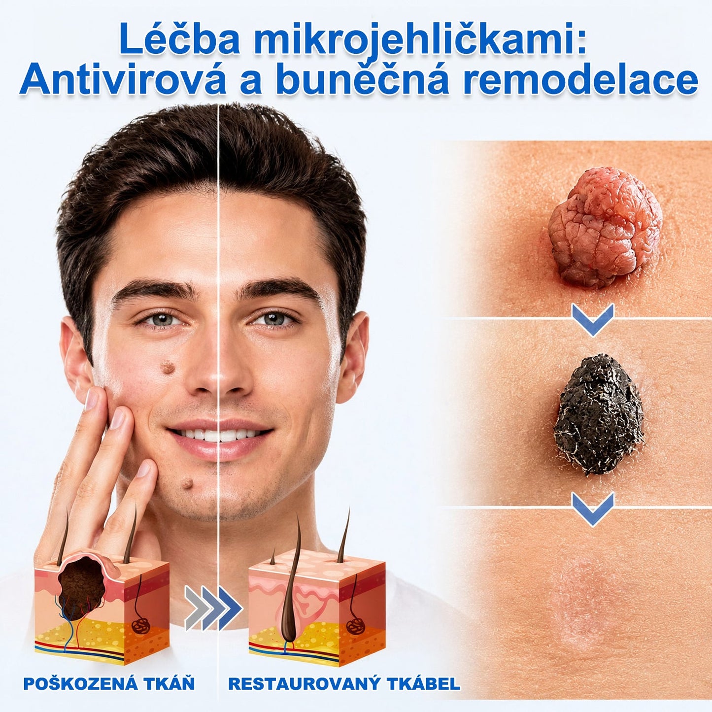 ✨🔥 50% SLEVA 🔥✨ PURESHADE® 2v1 mikrojehličková náplast 🍀 | Na znaménka, bradavice, akné a nedokonalosti pleti | Jemnější a čistší vzhled pokožky